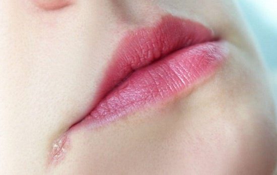 Angular Cheilitis Treatment Market