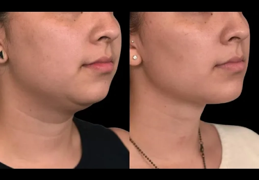 Double Chin removal