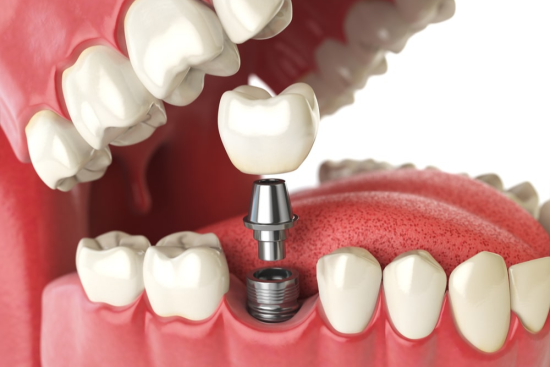 Dental Implant