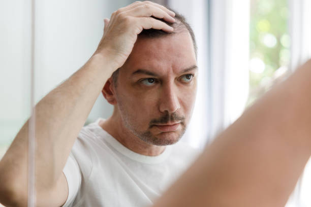 Dermatologists Prescribe for Hair Loss in Females