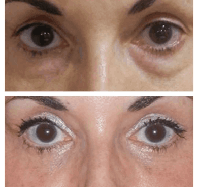 Eye Bag Removal