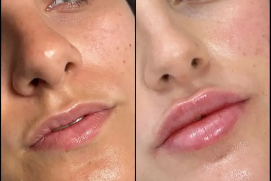 Juvederm