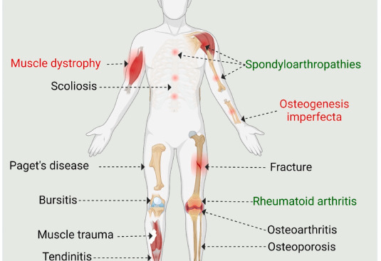 Musculoskeletal Disorders in human