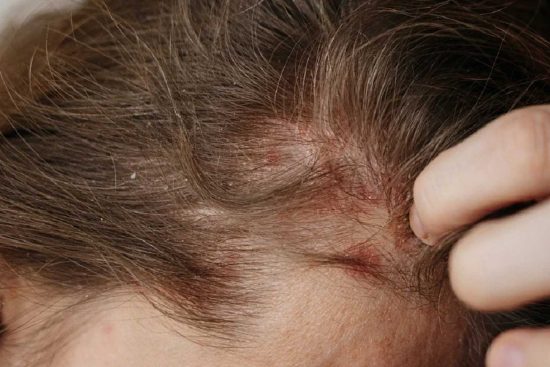 can eczema cause bald spots