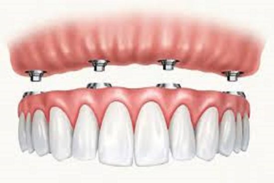 dental implants