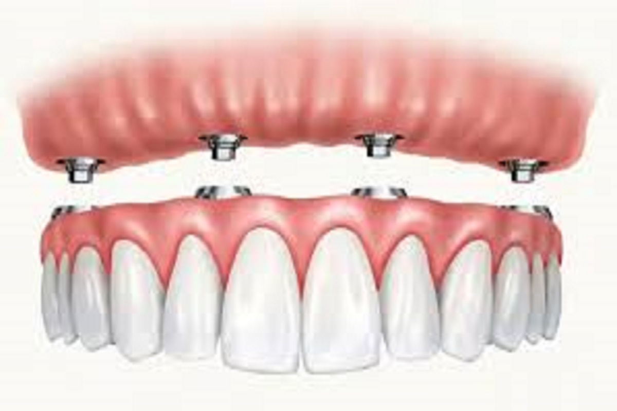 dental implants