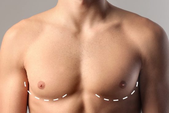 Gynecomastia-banner-blog