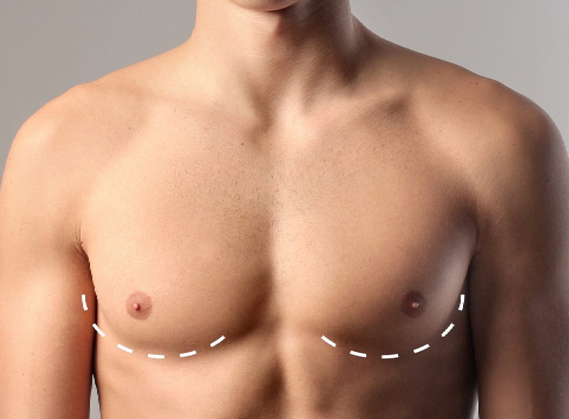 Gynecomastia-banner-blog