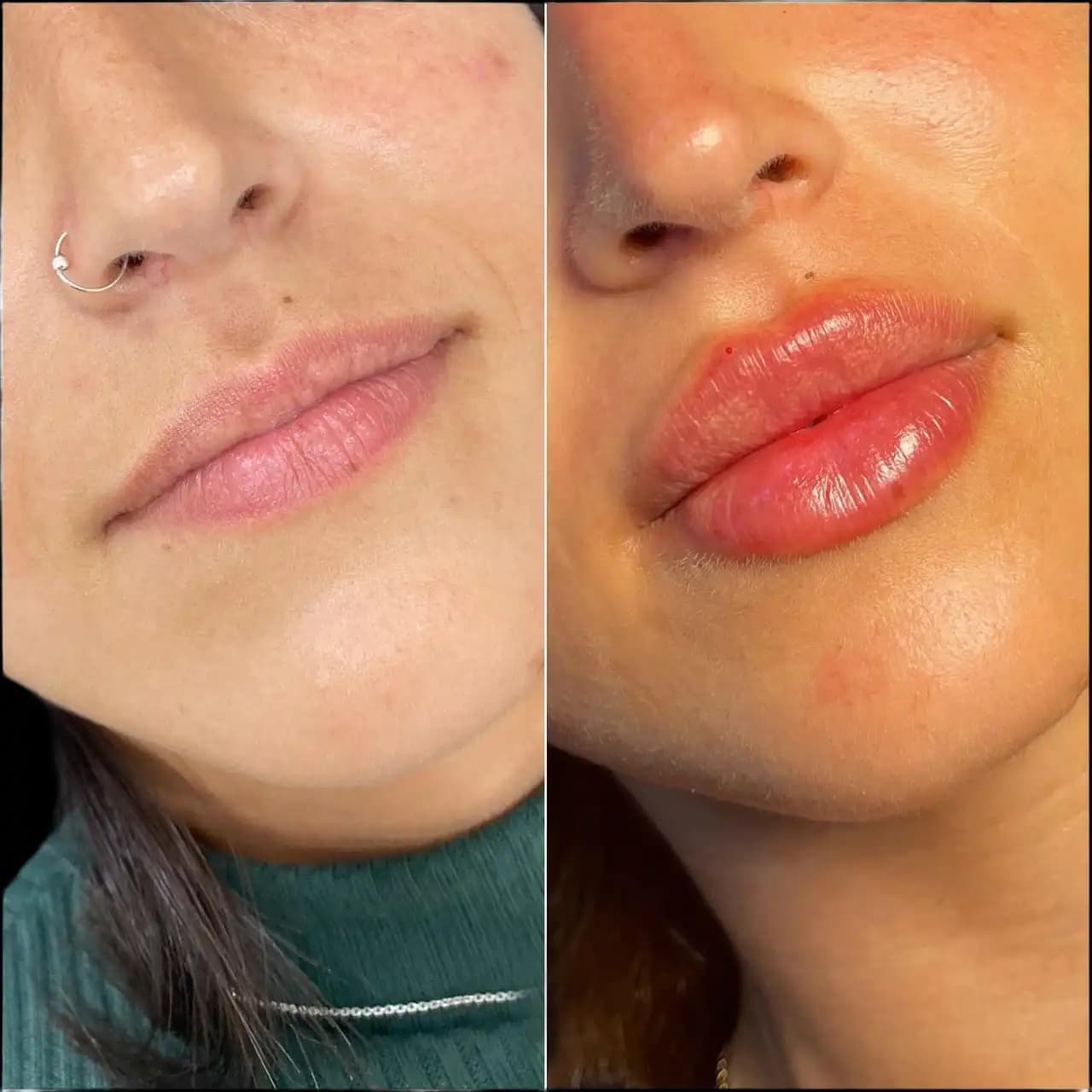 H2-lip-fillers