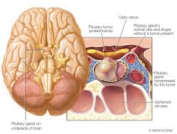 Prolactinoma