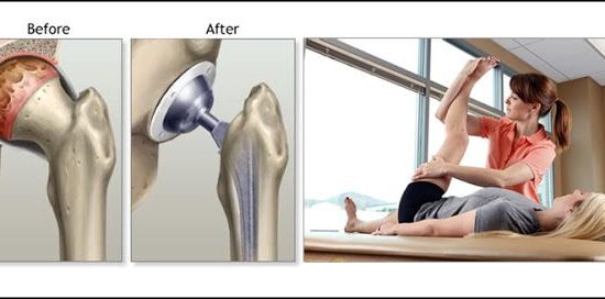 hip replacement recovery