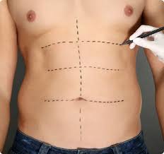 Liposuction surgery in Lahore