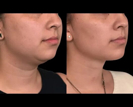 Double chin removal