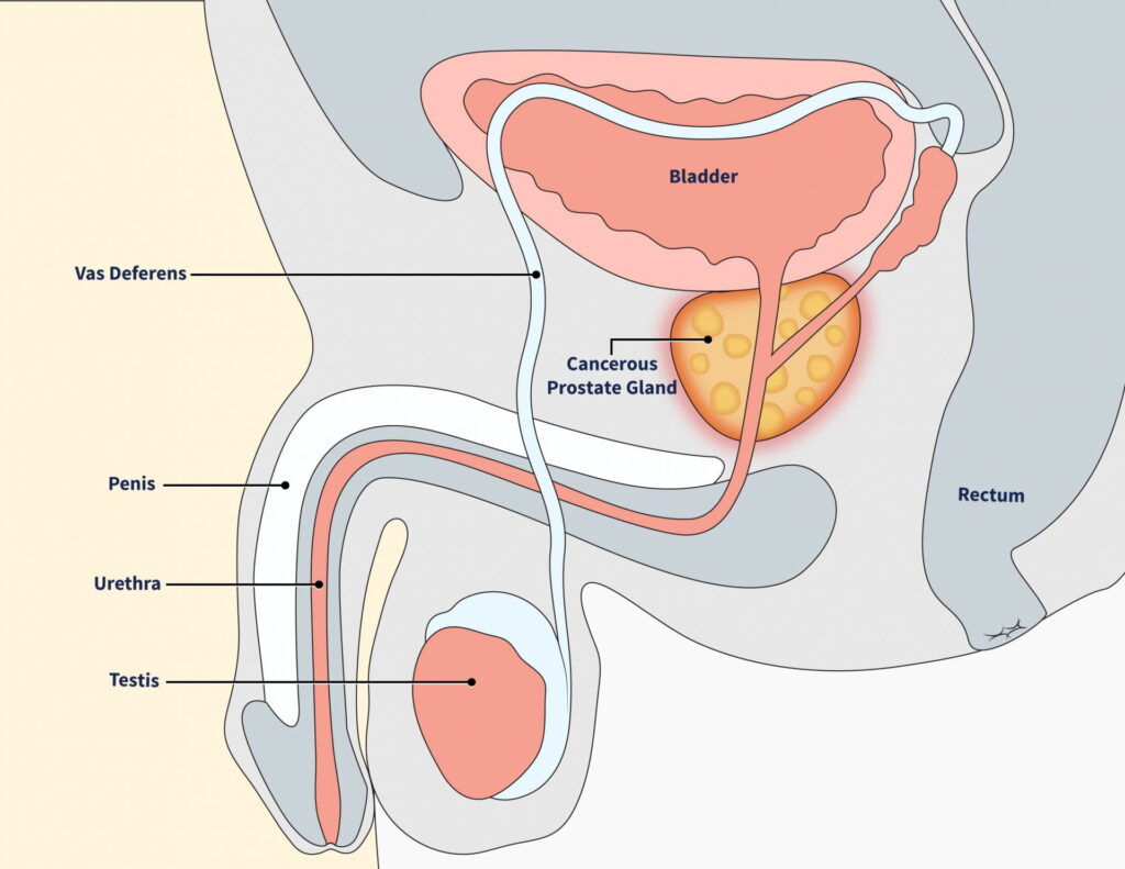 Erectile dysfunction 5