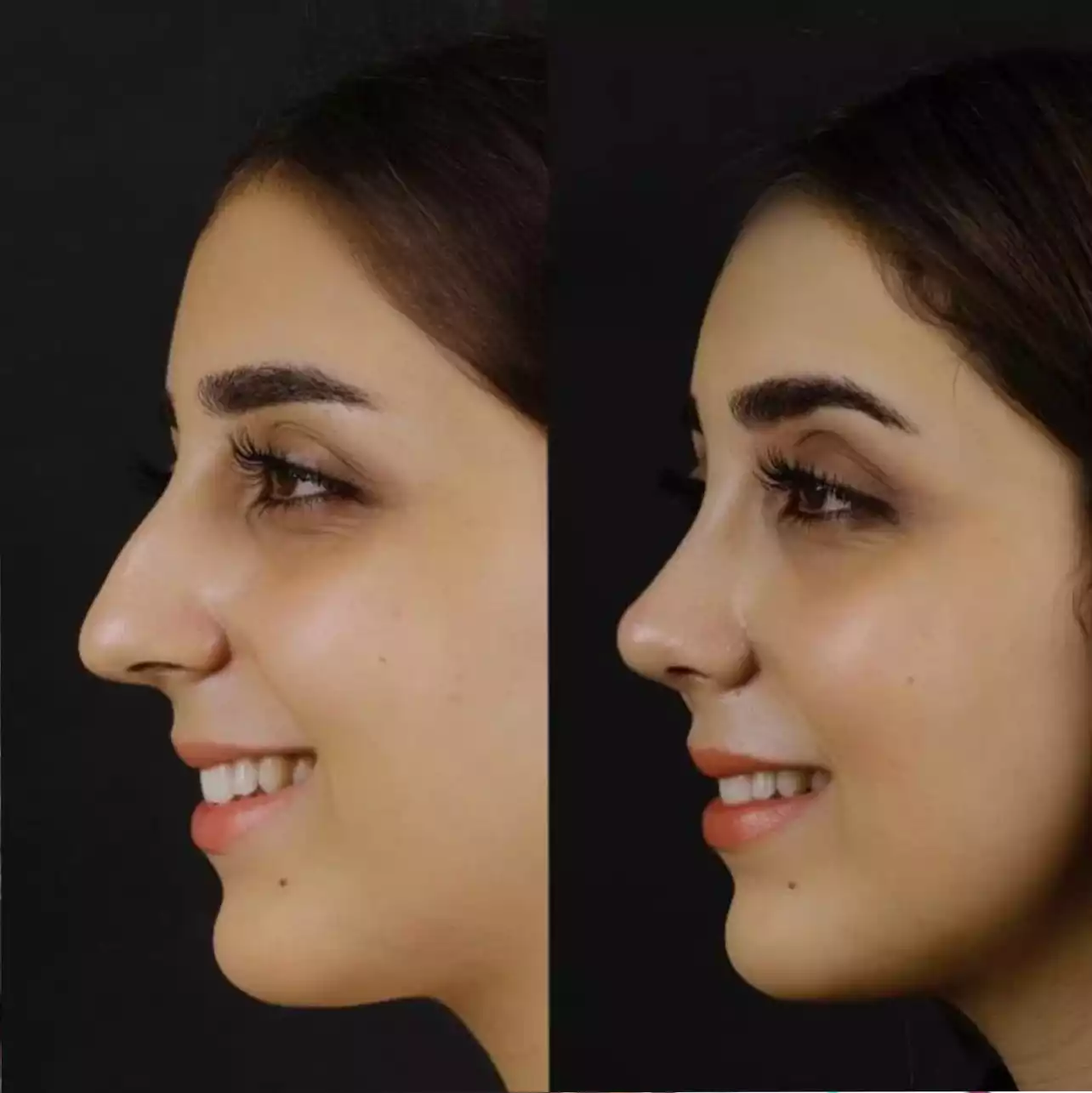 H-Rhinoplasty4-copy