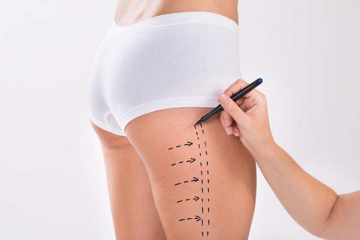 Liposuction for Outer Thighs Streamlining Leg Silhouette