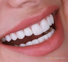 Veneers Dubai