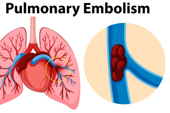 pulmonary embolism