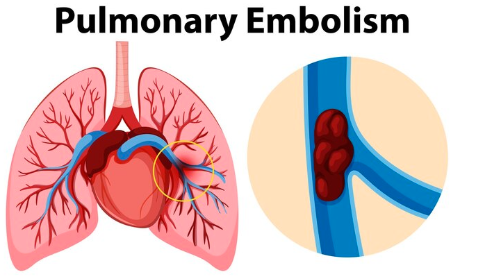 pulmonary embolism