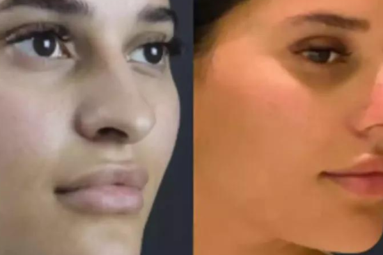 Rhinoplasty in Dubai: Cost, Procedure, and Expected Results