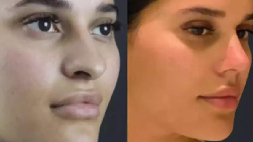 Rhinoplasty in Dubai: Cost, Procedure, and Expected Results