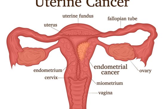 uterine-cancer