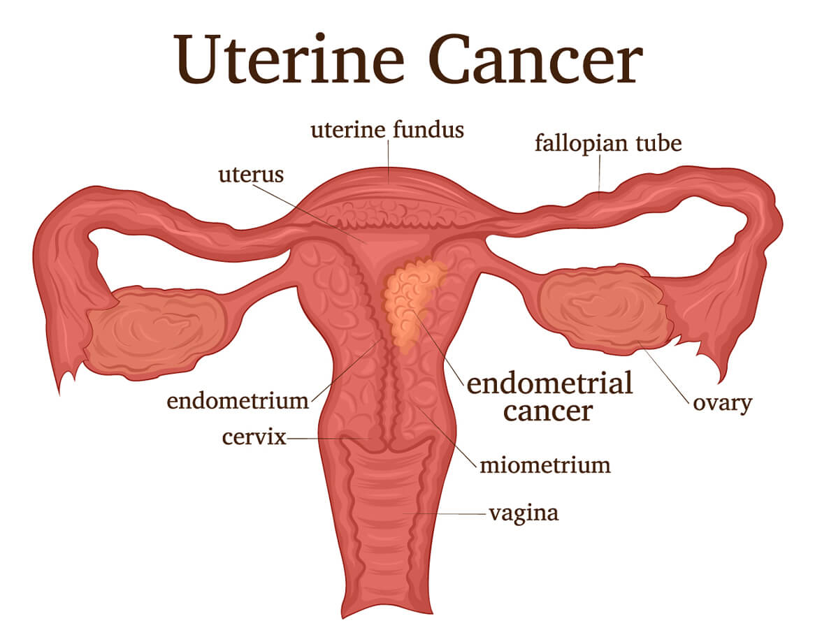 uterine-cancer