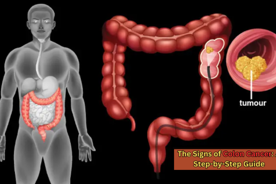 The Signs of Colon Cancer A Step-by-Step Guide