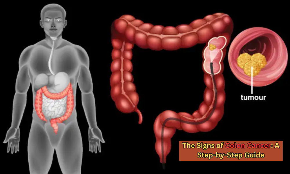 The Signs of Colon Cancer A Step-by-Step Guide