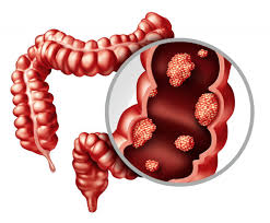 Colorectal cancer treatment in Singapore